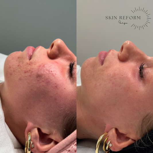 Acne Bootcamp Client!